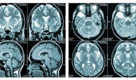 Abordaje del dolor neuropático asociado a Esclerosis Múltiple