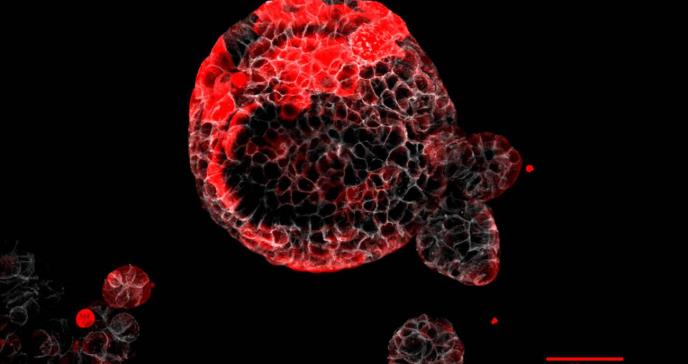 Células HRC serían las encargadas de la metástasis y reaparición del cáncer de colon