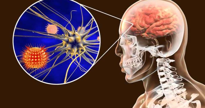 Tres pacientes fallecieron por brote de meningitis aséptica