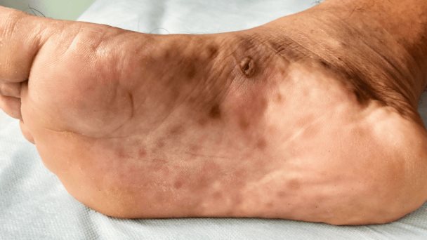 Sífilis: tratamiento antibiótico para esta enfermedad de transmisión sexual