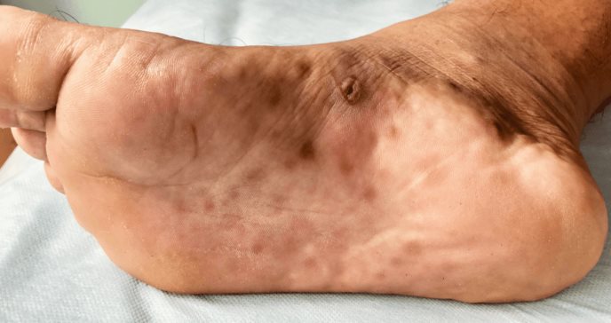 Sífilis: tratamiento antibiótico para esta enfermedad de transmisión sexual