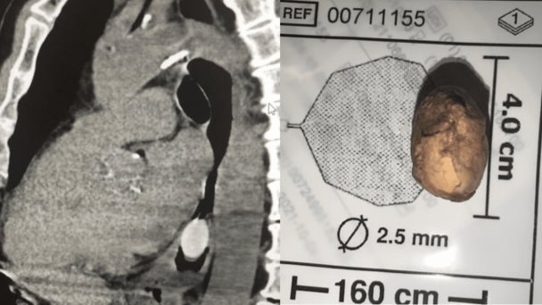 Extraen quenepa localizada en el esófago mediante endoscopía en paciente puertorriqueño Extraen quenepa localizada en el esófago mediante endoscopía en paciente puertorriqueño