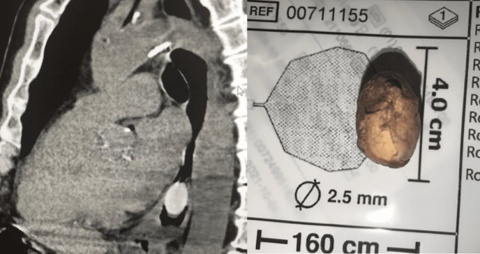 Extraen quenepa localizada en el esófago mediante endoscopía en paciente puertorriqueño