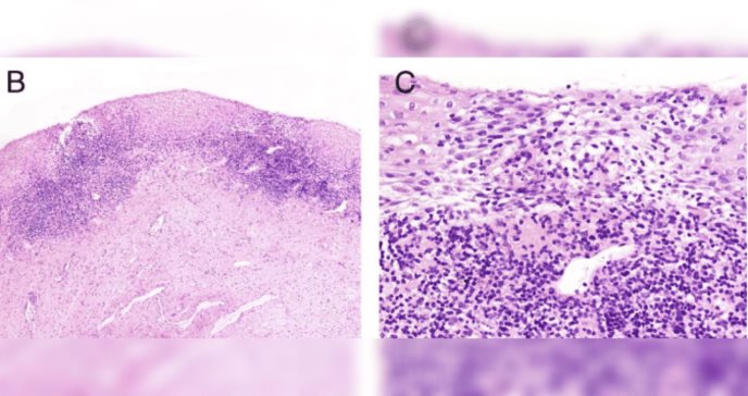 Vaginitis inflamatoria, vulvitis de células plasmáticas y el riesgo de vaginitis hemorrágica