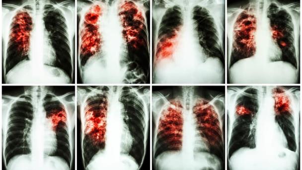 Fumar marihuana produce daño crónico a las vías respiratorias y problemas cardiovasculares Fumar marihuana produce daño crónico a las vías respiratorias y problemas cardiovasculares