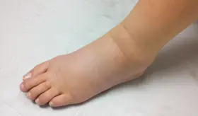 Pies hinchados: causas y síntomas