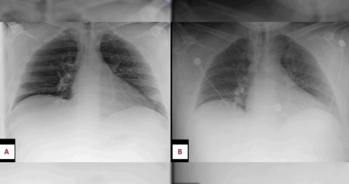 Reportan síndrome inflamatorio multisistémico en paciente que superó un paro cardíaco y el COVID-19