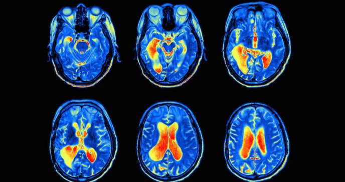 Investigadores descubren patrón genético en trastorno por déficit de atención con hiperactividad (TDAH)