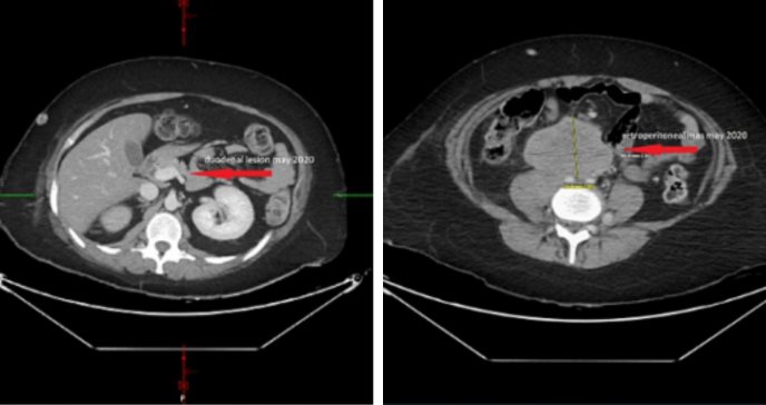 Paciente puertorriqueña presentó sangrado gastrointestinal agudo por un carcinoma en el cuello uterino