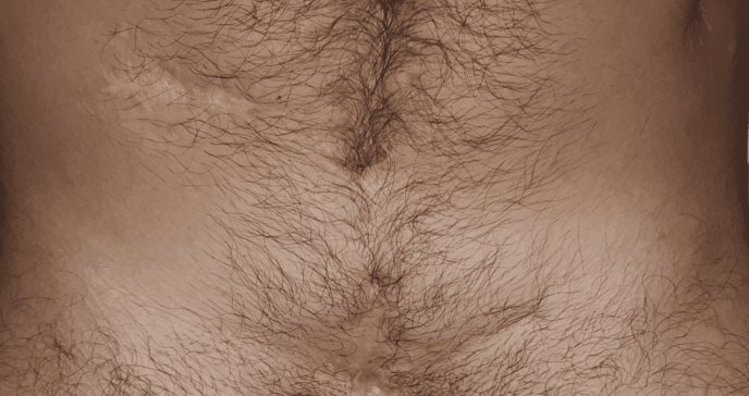 La importancia del uso de mallas biológicas para una reconstrucción abdominal
