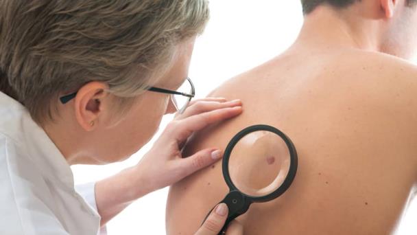 El melanoma no es el único cáncer de piel grave