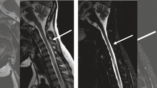 Paciente con lupus eritematoso sistémico desarrolló mielitis transversa por infección de influenza A Paciente con lupus eritematoso sistémico desarrolló mielitis transversa por infección de influenza A