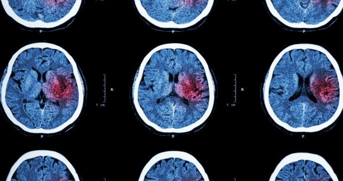 Stroke: causa principal de discapacidad a largo plazo en pacientes puertorriqueños, según estudio