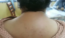 Síndrome de Cushing y las señales del exceso de cortisol en el cuerpo