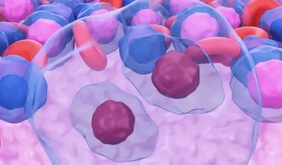 ¿Cómo y cuando se sospecha de un Linfoma de Hodgkin?