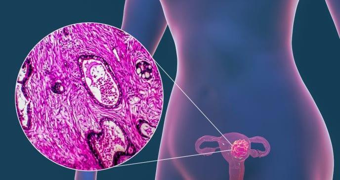 Cómo se inicia el cáncer de ovario en las mujeres con más riesgo