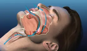 La apnea obstructiva del sueño aumenta el riesgo de pérdida auditiva