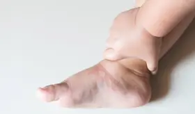 Síndrome nefrótico: hinchazón y acumulación de líquidos en extremidades