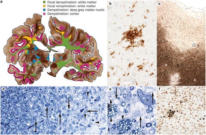 Insights Into the Molecular Pathogenesis of Progression in Multiple Sclerosis