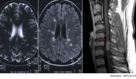 Revisión de la esclerosis múltiple - diagnóstico y tratamiento