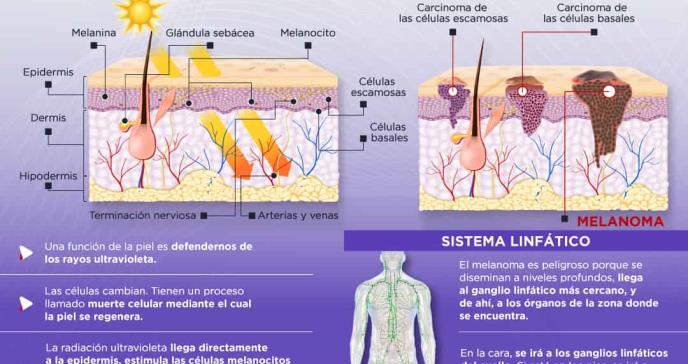 ¿Cómo se forma un melanoma? - Infografía