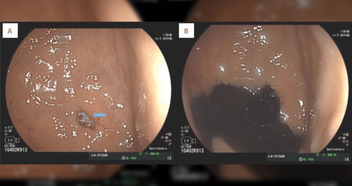 Logran reparar fístula gastrobronquial mediante cirugía abierta