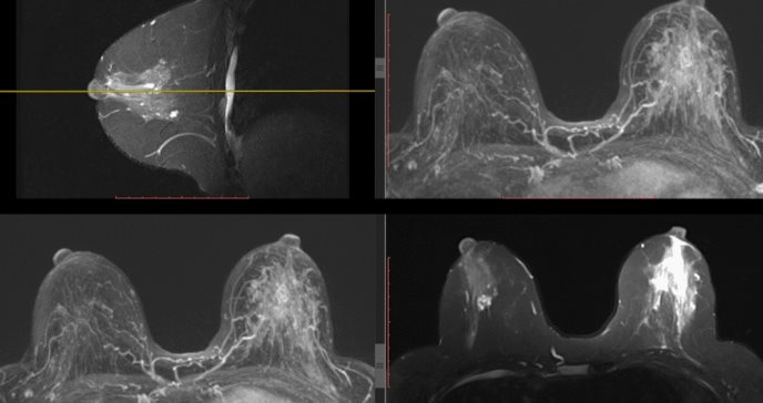 Vacuna experimental contra el cáncer de mama demuestra seguridad en primera fase de ensayos clínicos