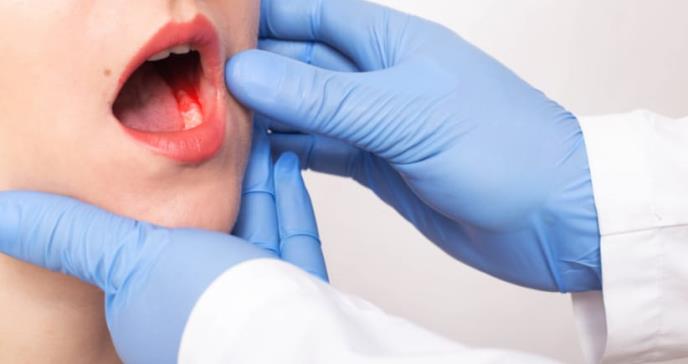 Tipos de efectos bucales que pueden originar algunos tratamientos contra el cáncer