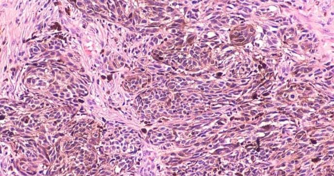 Estimulación eléctrica: técnica usada para manejar el dolor e inflamación en el cáncer