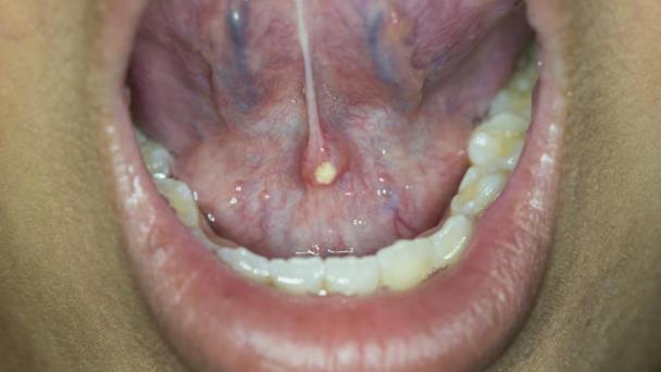 ¿Sialoendoscopia o botox?: Tratamientos actualizados y efectivos para el manejo de tumores salivales ¿Sialoendoscopia o botox?: Tratamientos actualizados y efectivos para el manejo de tumores salivales