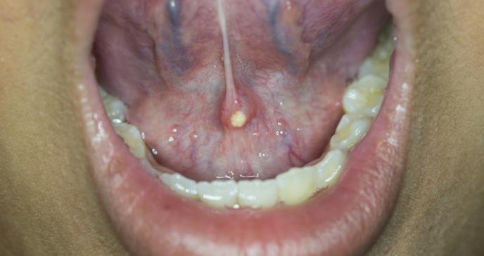 ¿Sialoendoscopia o botox?: Tratamientos actualizados y efectivos para el manejo de tumores salivales