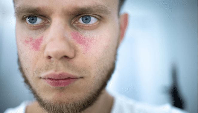 La pérdida o envejecimiento de linfocitos está detrás del daño cardiovascular por lupus o artritis