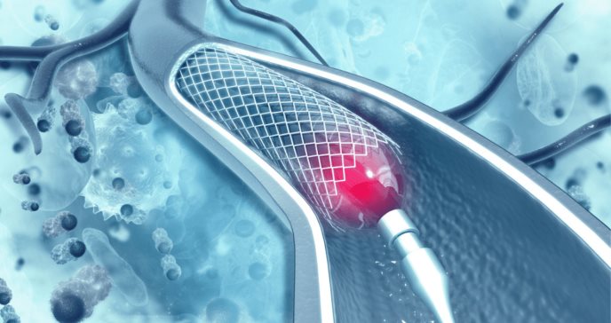 Conoce todo sobre la trombosis de stent
