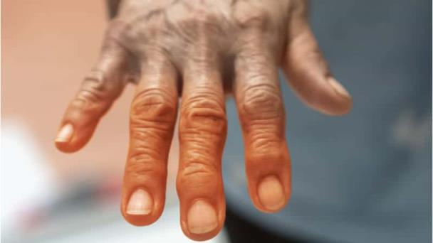 ¿Existe relación entre la diabetes y la artritis reumatoide? ¿Existe relación entre la diabetes y la artritis reumatoide?