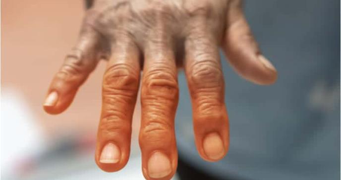 ¿Existe relación entre la diabetes y la artritis reumatoide?
