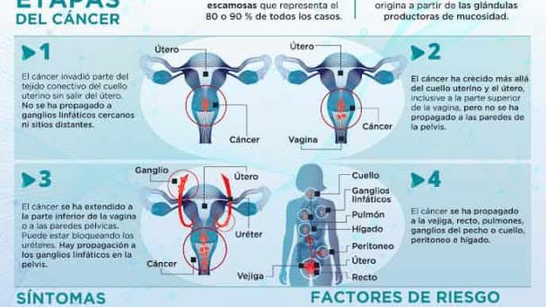 Cáncer cervicouterino - Infografía