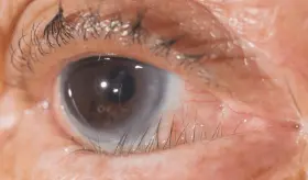 Triquiasis palpebral: lo que sucede cuando las pesta&ntilde;as crecen hacia el interior del ojo