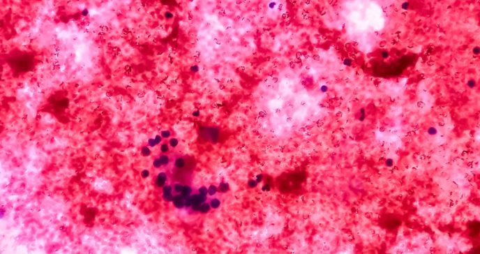 Creada la primera guía para el tratamiento de hipercalcemia maligna, enfermedad asociada con el cáncer