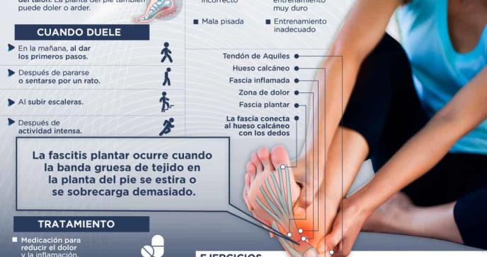 Fascitis plantar - Infografía