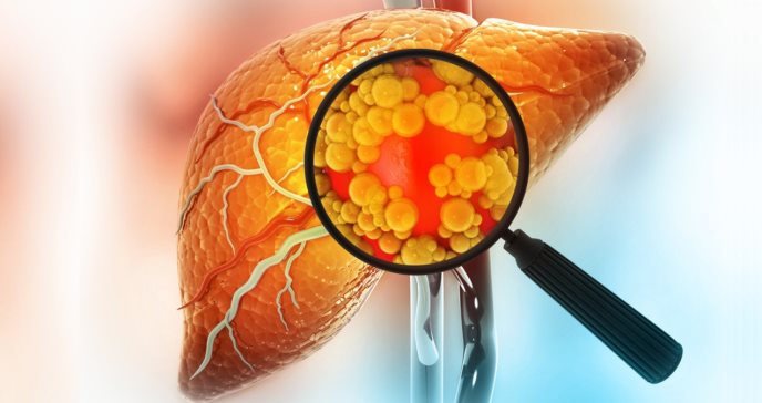 Alto riesgo de daño hepático y cáncer en personas con obesidad o diabetes por ingesta de comidas rápidas
