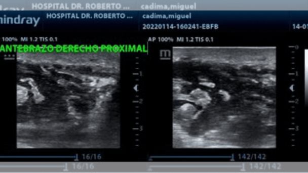 Ecografía en el punto de atención es sensible y específica para diagnóstico de fascitis necrosante Ecografía en el punto de atención es sensible y específica para diagnóstico de fascitis necrosante