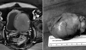 Registran primer caso de paciente puertorriqueño con leiomiomas en vejiga