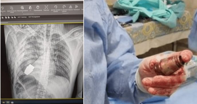 Arriesgada operación: le sacaron una granada del pecho a un soldado ucraniano sin que explotara