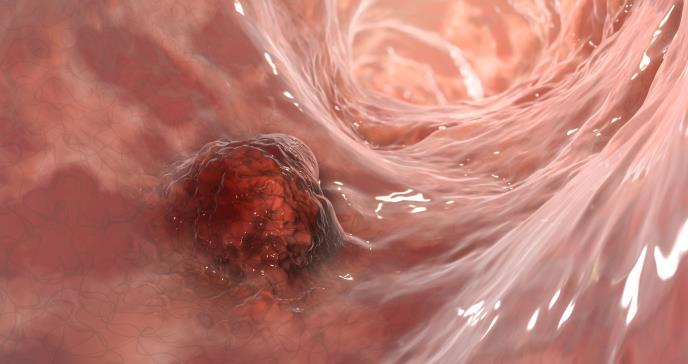 Nuevas directrices para el tratamiento del cáncer colorrectal de aparición temprana