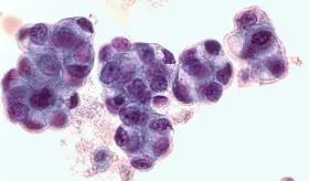 Incidencia del estrés crónico en respuesta a tratamiento T-Cell en pacientes con cáncer de ovario seroso