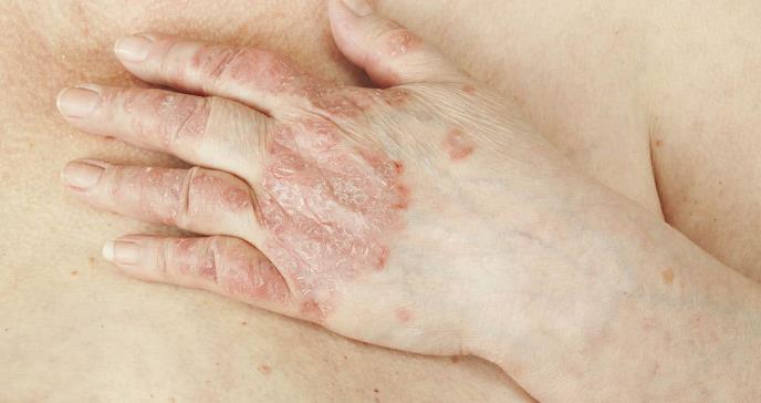 Medicamentos biológicos van a la raíz del problema de la artritis psoriásica