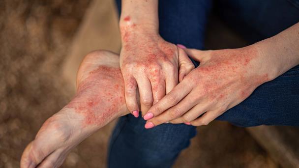 Nuevas pautas para el tratamiento de la dermatitis atópica en adultos