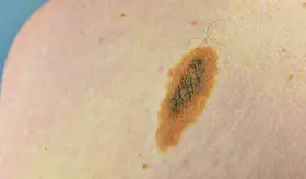 Pruebas genéticas y campañas educativas inciden en hábitos preventivos del cáncer de piel en Puerto Rico