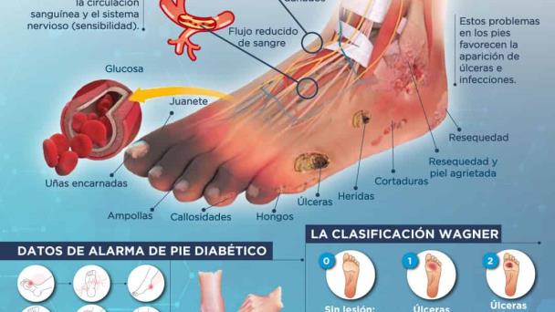 Pie diabético - Infografía