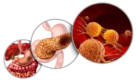 Así se puede detectar el cáncer de páncreas